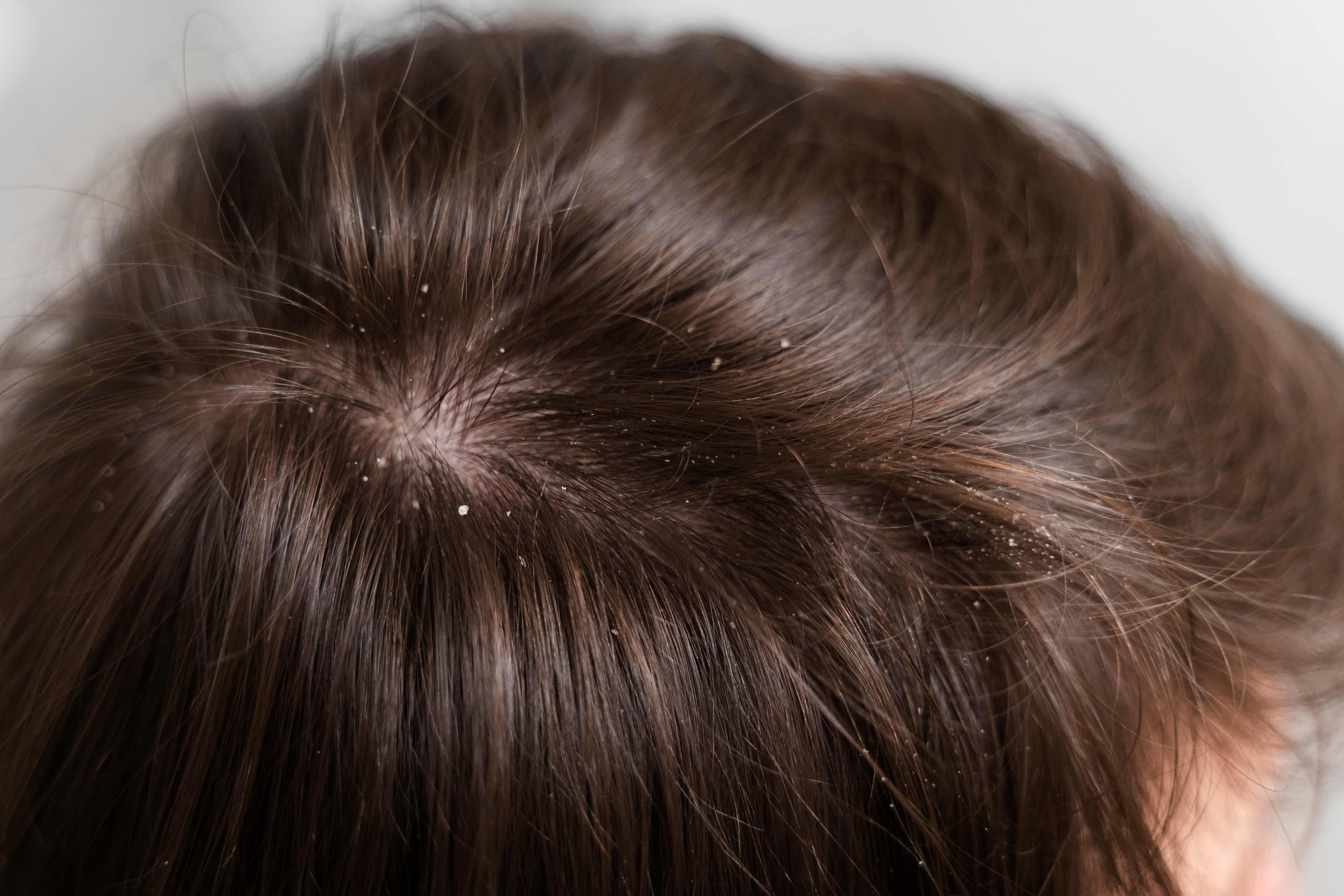 Ayurvedic Dandruff Treatment: Natural Remedies for Itchy Scalp