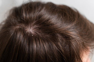 Ayurvedic Dandruff Treatment: Natural Remedies for Itchy Scalp